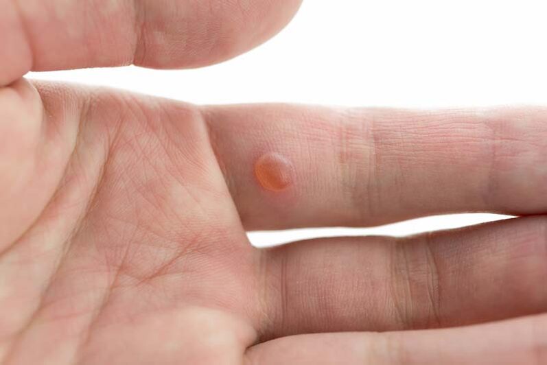 Unha verruga no dedo que se pode eliminar con remedios populares