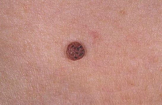 Papilloma procesado