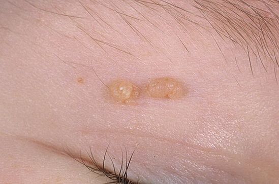 Papiloma ordinario