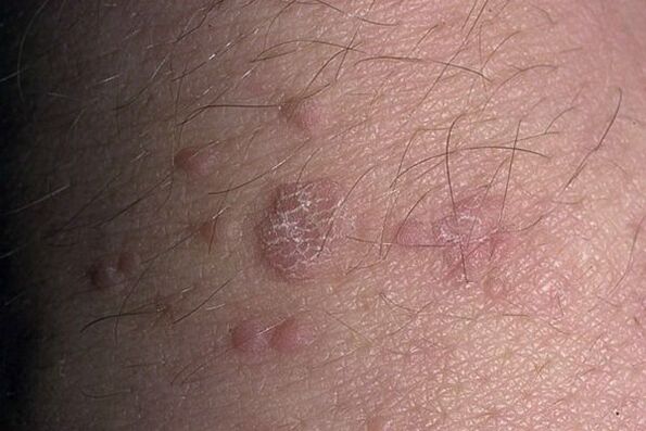 Papiloma plano