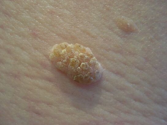 Papiloma