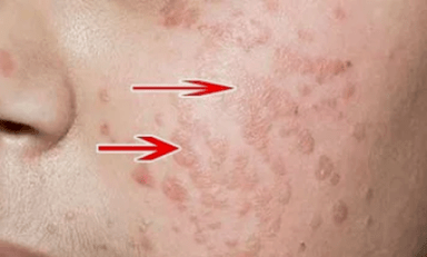 Como recoñecer o virus do papiloma humano