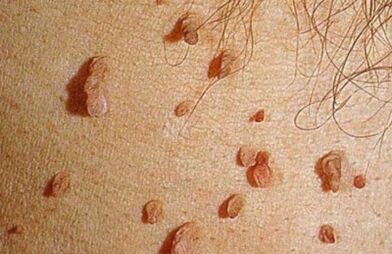Como se manifesta o virus do papiloma humano