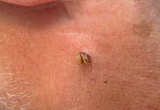 Papiloma no pescozo