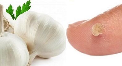 Tratamento das verrugas con remedios populares