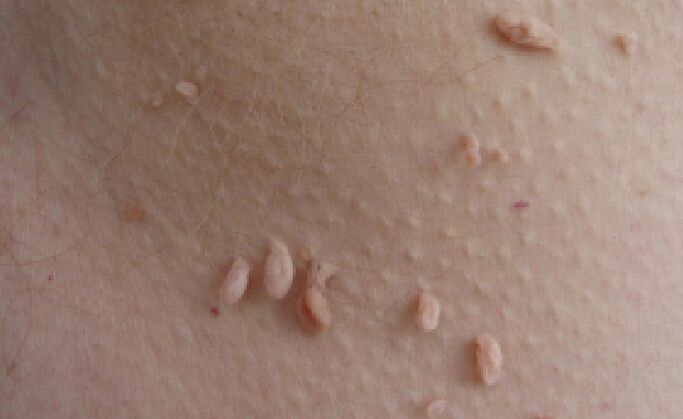 Razóns para a aparición de papilomas no corpo humano