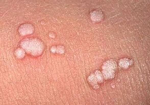 papilomas vulgares no corpo humano