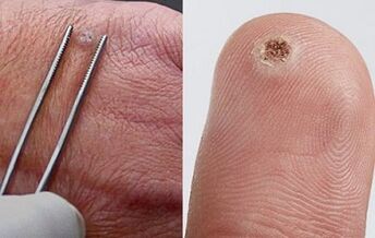 Síntomas de papilomas no corpo humano