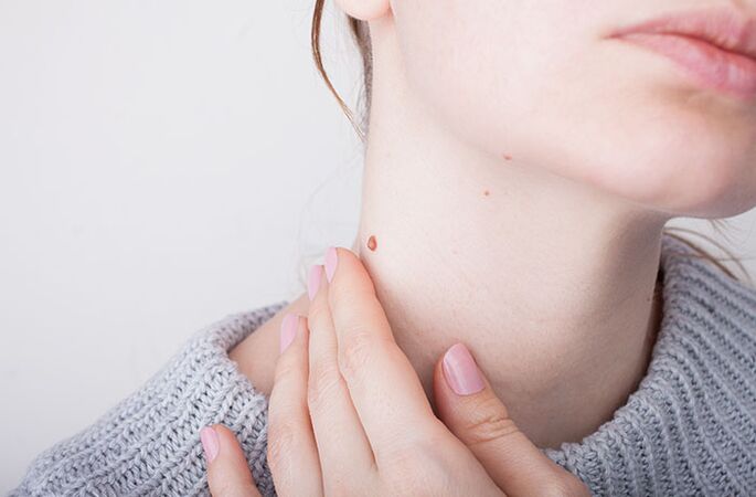 Unha verruga é o principal síntoma do virus do papiloma humano. 