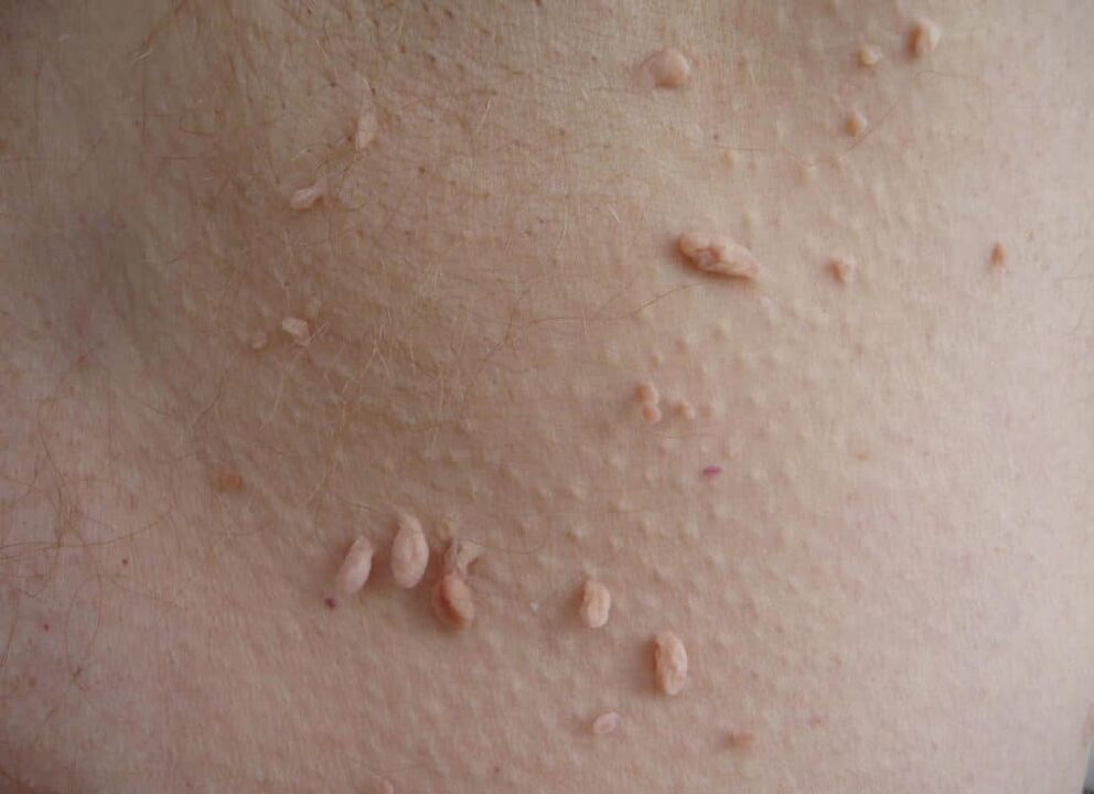 Tipos de papilomas no pescozo