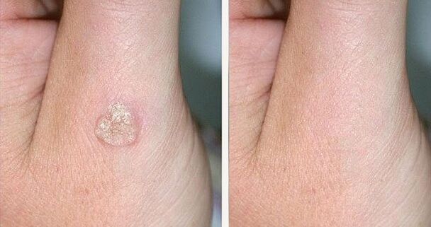 Fotos antes e despois da eliminación de verrugas con remedios naturais