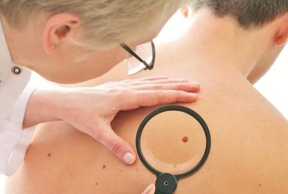 O médico determina o tipo de papiloma na pel